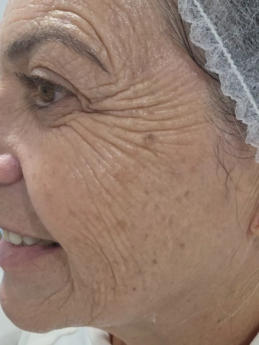 Antes — Rosto e Olhos