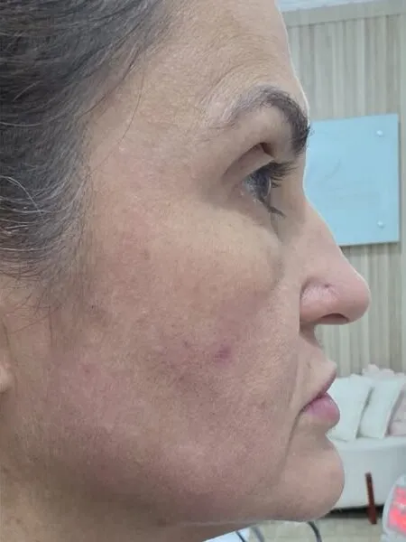 Depois — Perfil Lateral (8 dias)