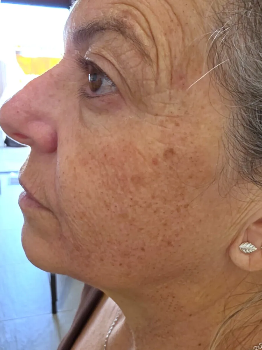 Depois — Rosto e Olhos